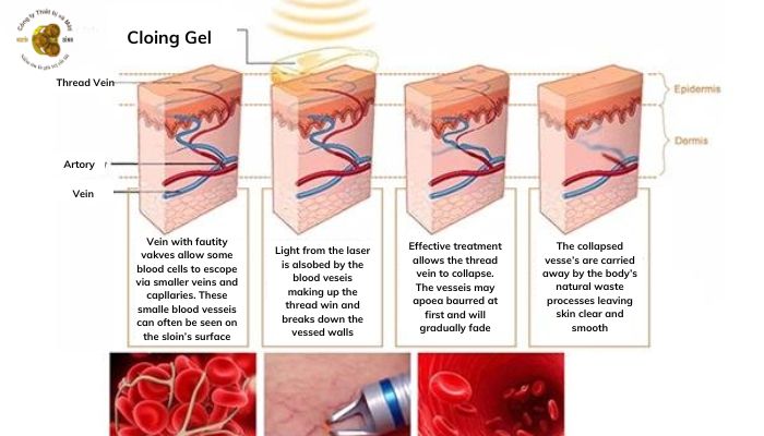 Ưu điểm máy trị giãn mao mạch Q2Long