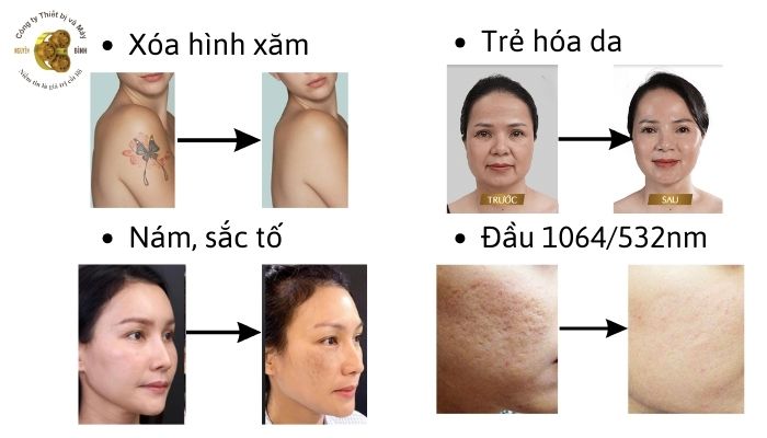 Hiệu quả điều trị của máy SOLIS VO6