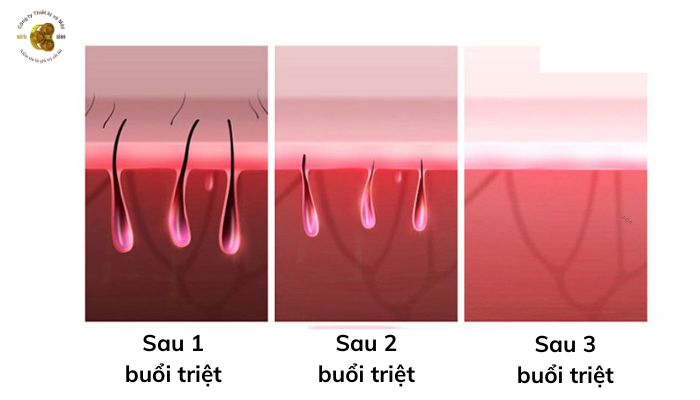 Lí do nên chọn máy triệt lông