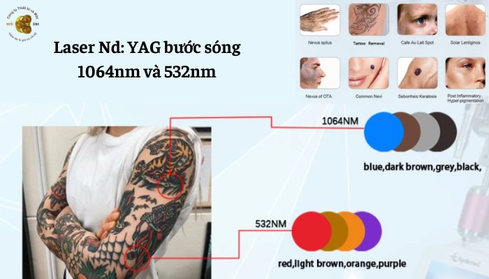 Công nghệ Laser Nd YAG là gì?