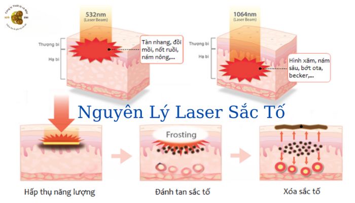 Công nghệ Laser YAG hoạt động như thế nào?