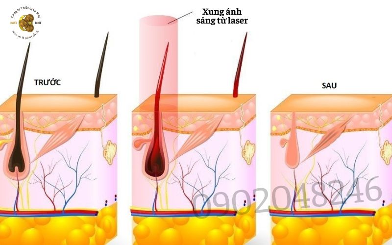 Laser triệt lông hoạt động như thế nào