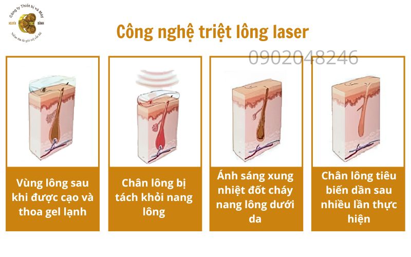 công nghệ máy triệt lông