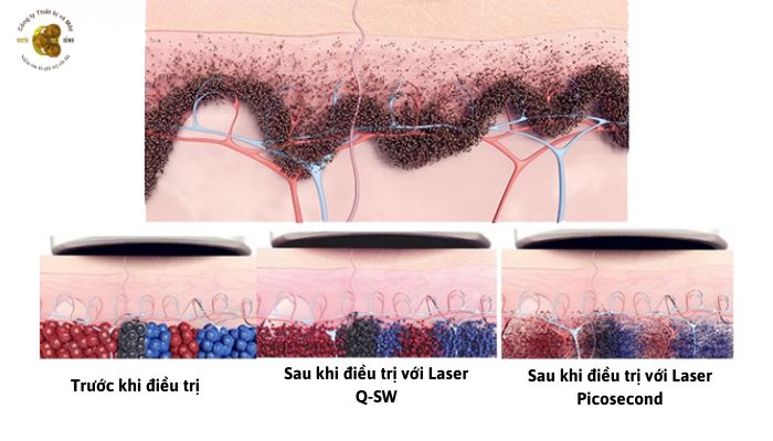 Công nghệ Laser Picosecond trong máy SOLIS VO3