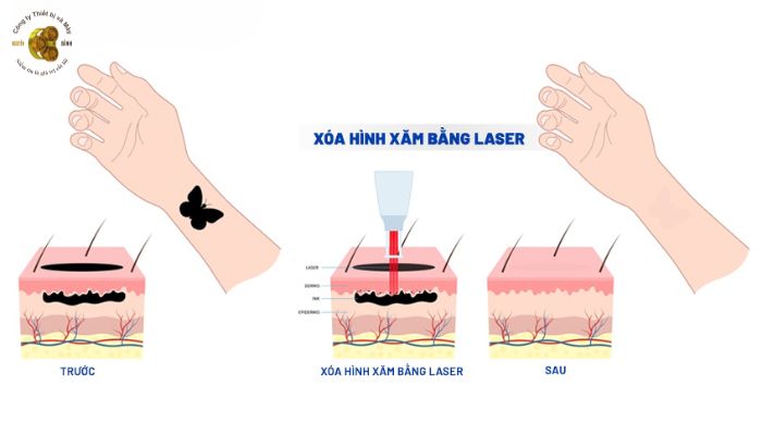 Sử Dụng Máy Xóa Xăm Hiệu Quả