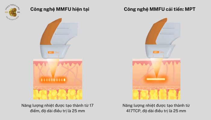 Công nghệ hiện đại của máy Hifu Shurink Universe