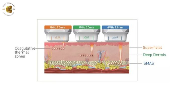 Máy Hifu Shurink phát được tới các lớp cân cơ SMAS