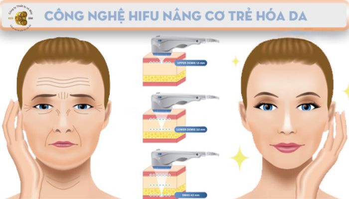 Công nghệ Linear Firm nâng cơ trẻ hóa da