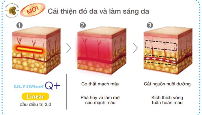 Hiệu quả nâng cơ sau một lần điều trị