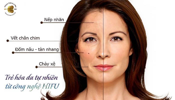 Đối tượng nên thực hiện phương pháp nâng cơ HIFU