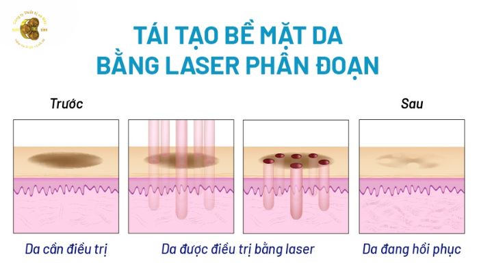 Laser CO2 Fractional Edge One hoạt động