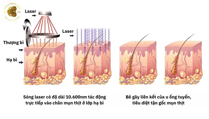 Laser CO2 Fractional Edge One là gì?”