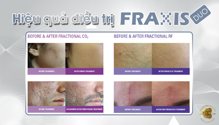 Hình ảnh trước và sau khi điều trị bằng Laser CO2 Fractional FRAXIS DUO