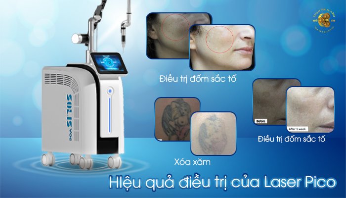 Hiệu quả của Laser Pico trong thẩm mỹ.