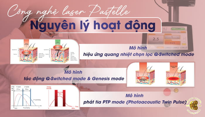 Công nghệ laser Pastelle và nguyên lý hoạt động