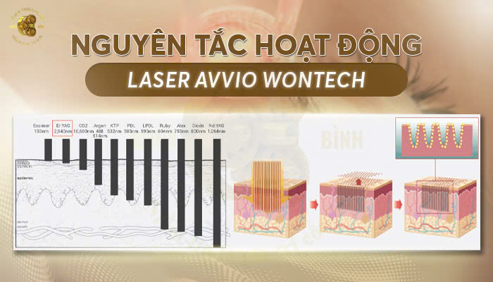 Nguyên tắc hoạt động của máy Laser AVVIO WONTECH