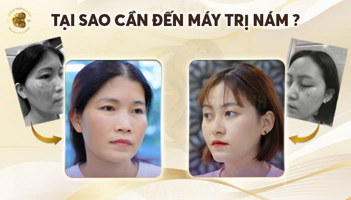 Tại sao cần đến máy trị nám