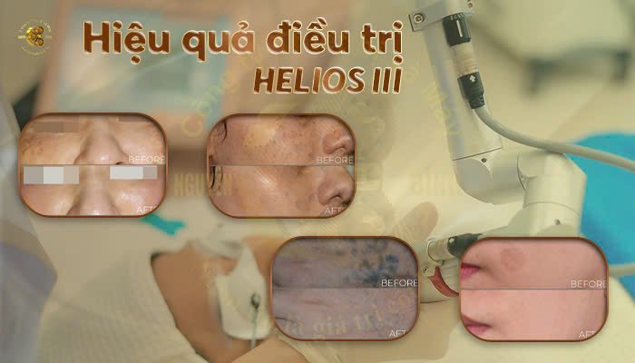 Hiệu quả điều trị Máy Laser Helios III ( Helios 3 )