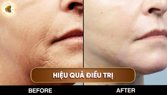Hiệu quả điều trị của máy Laser CO₂ Fractional Scahil