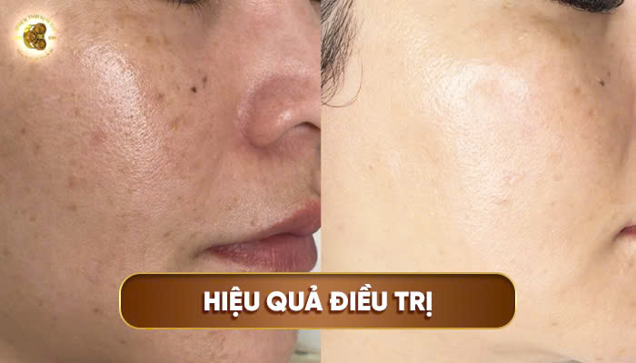 Hiệu quả điều trị