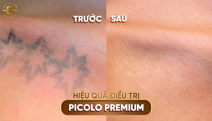 Hiệu quả điều trị của máy Laser PicoLO Premium