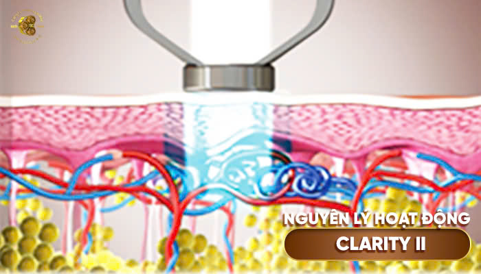 Nguyên lý hoạt động của Lutronic Clarity II