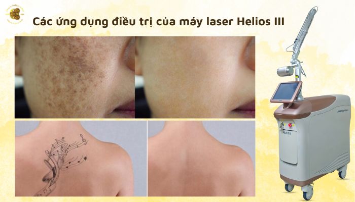 Các ứng dụng điều trị của máy laser Helios III