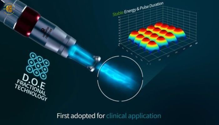Công nghệ mới nhất của máy laser Helios III