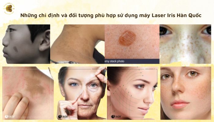 Những chỉ định và đối tượng phù hợp sử dụng máy Laser Iris Hàn Quốc