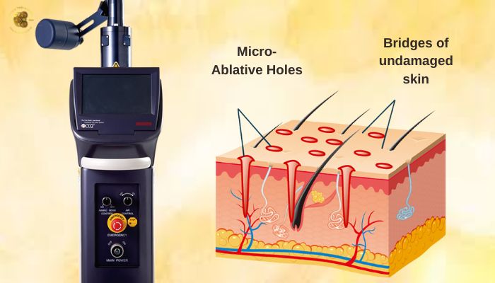 Cấu tạo và công nghệ tích hợp trong Laser eCO2 Lutronic