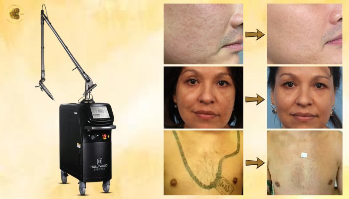 Những chỉ định điều trị của máy Laser Hollywood Spectra Hàn Quốc