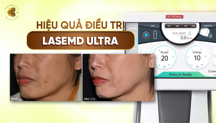 Lutronic LaseMD Ultra Hàn Quốc phù hợp với những ai?