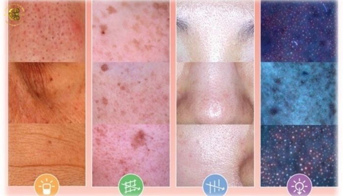 Ưu nhược điểm của máy phân tích da Focuskin Hàn Quốc