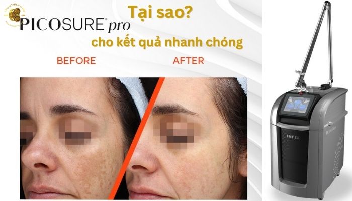 Tại sao Laser Picosure Pro cho kết quả nhanh chóng?