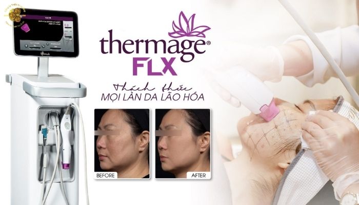 Nâng cơ bằng sóng RF có thật sự tốt không?