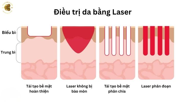 Laser Ultra 1927nm: Công nghệ tái tạo da thông minh thế hệ mới