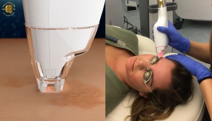 Ưu điểm nổi bật giúp Laser Ultra trở thành lựa chọn hàng đầu cho các cơ sở y khoa