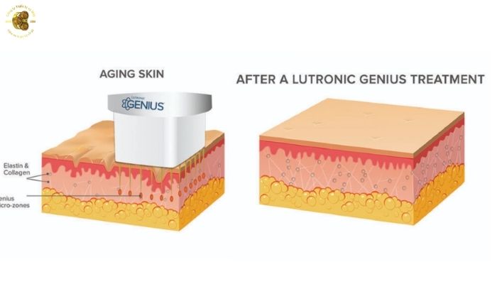 Cơ chế hoạt động của Genius RF trên làn da