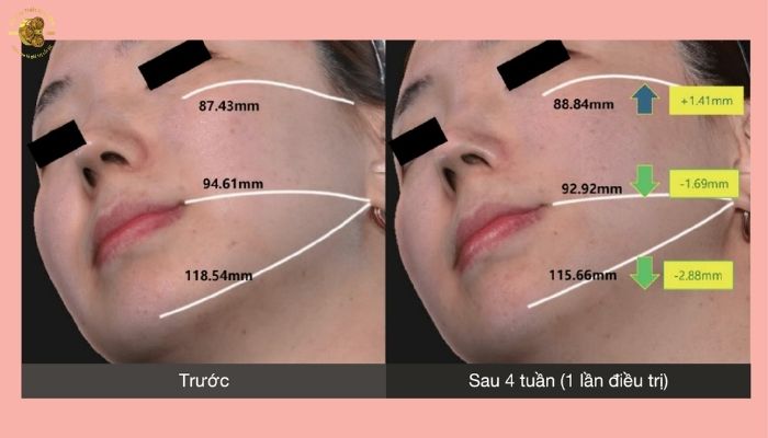 Hiệu quả điều trị của XERF Cynosure Lutronic