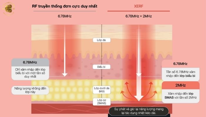 Ưu điểm và lợi ích khi dùng máy XERF Cynosure Lutronic