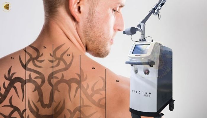 Xóa xăm thẩm mỹ