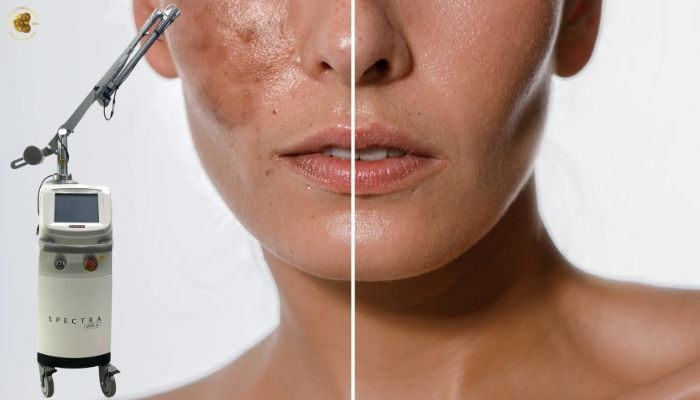 Điều trị nám và sắc tố da