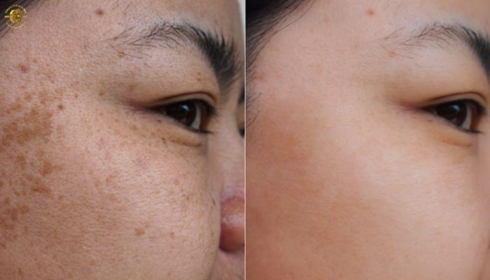 Những tiêu chí quan trọng khi chọn máy trị nám công nghệ cao cho thẩm mỹ viện