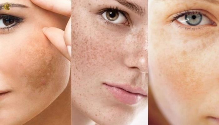 Vì sao thẩm mỹ viện cần đầu tư máy trị nám công nghệ cao?