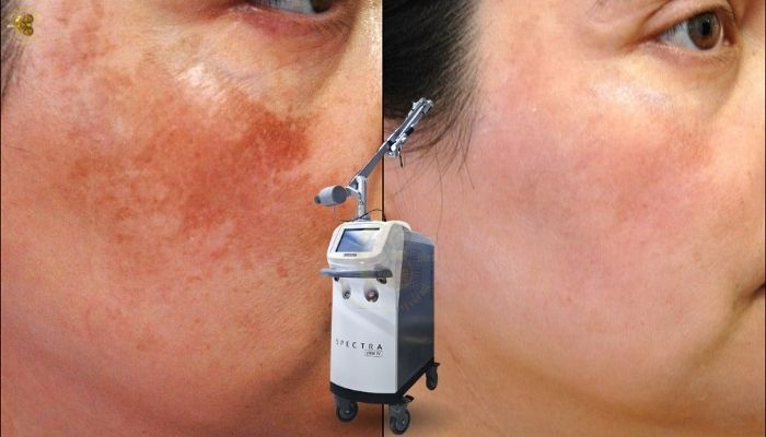 Máy trị nám công nghệ cao tại Thiết Bị Và Máy Nguyên Bình