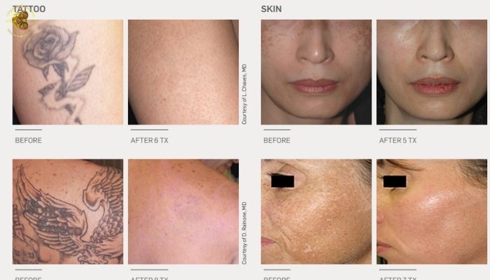 Ứng dụng của Revlite SI trong thẩm mỹ