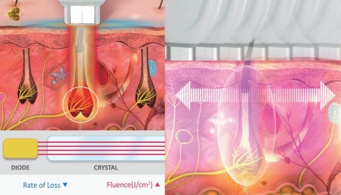 Máy triệt lông Diode Vikini Illoda hoạt động ra sao?