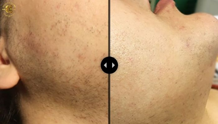 Cải thiện kết cấu và làm mềm bề mặt da