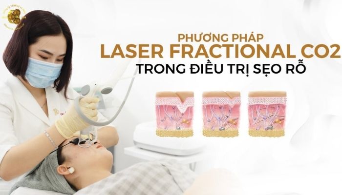 Laser CO2 trị sẹo có hiệu quả không?
