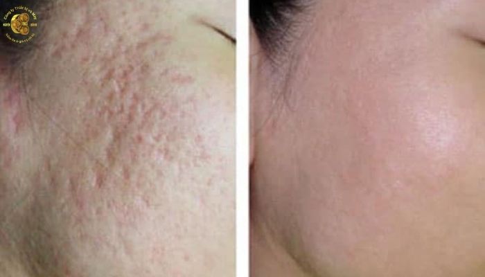 Làm thế nào để hạn chế nguy cơ để lại sẹo sau laser CO2?